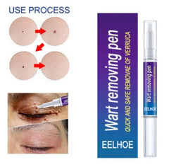EELHOE Wart Removing Pen | Remove Moles, Skin Tags & Warts Quickly and Safely