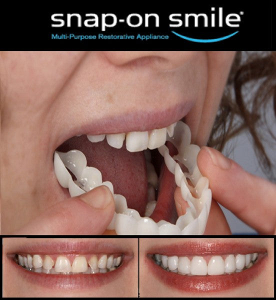 Snap-On Smile Teeth – Instant Perfect Smile | Natural White Veneers | Comfortable & Removable Teeth Cover